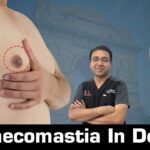 gynecomastia in Delhi