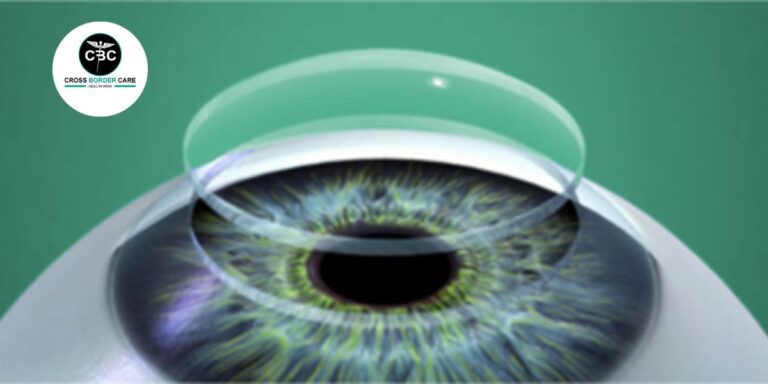 Corneal Transplant Surgery