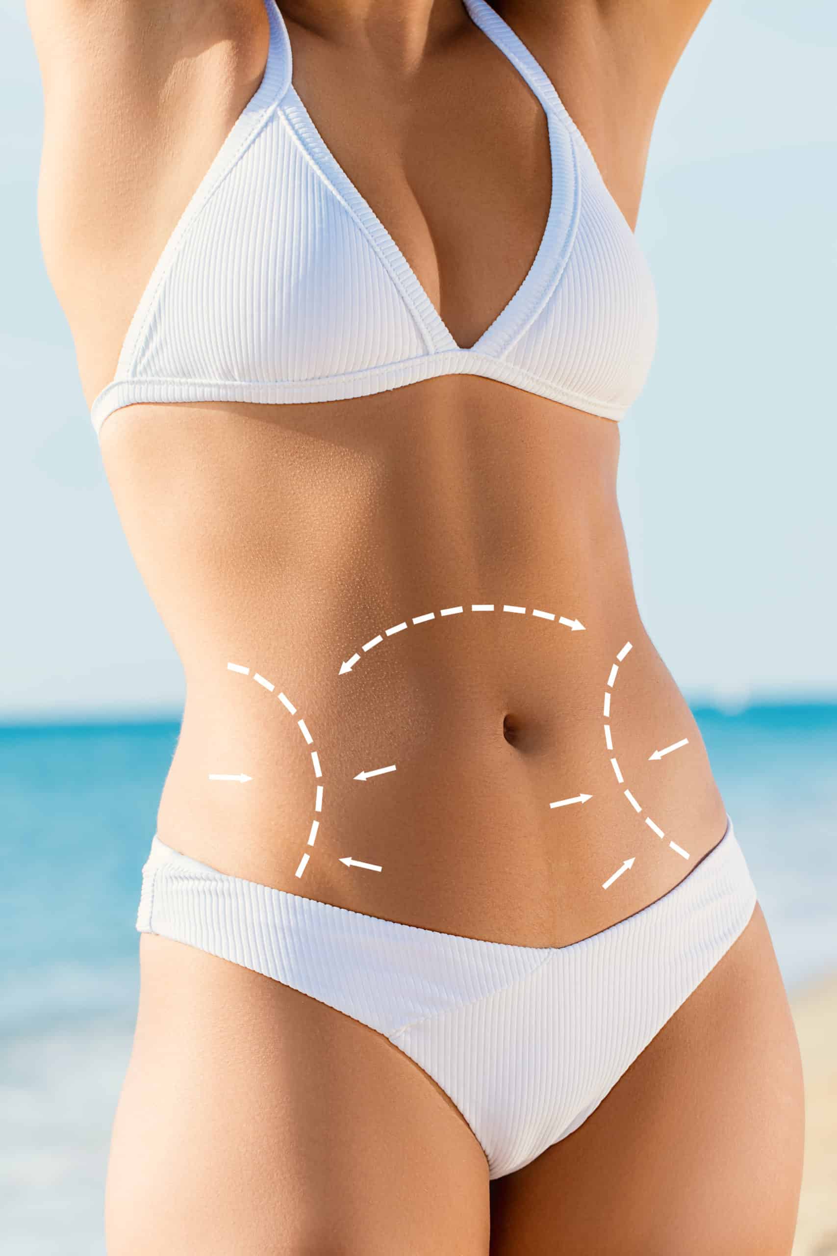 Liposuction Surgery in Dubai Key Benefits and Considerations