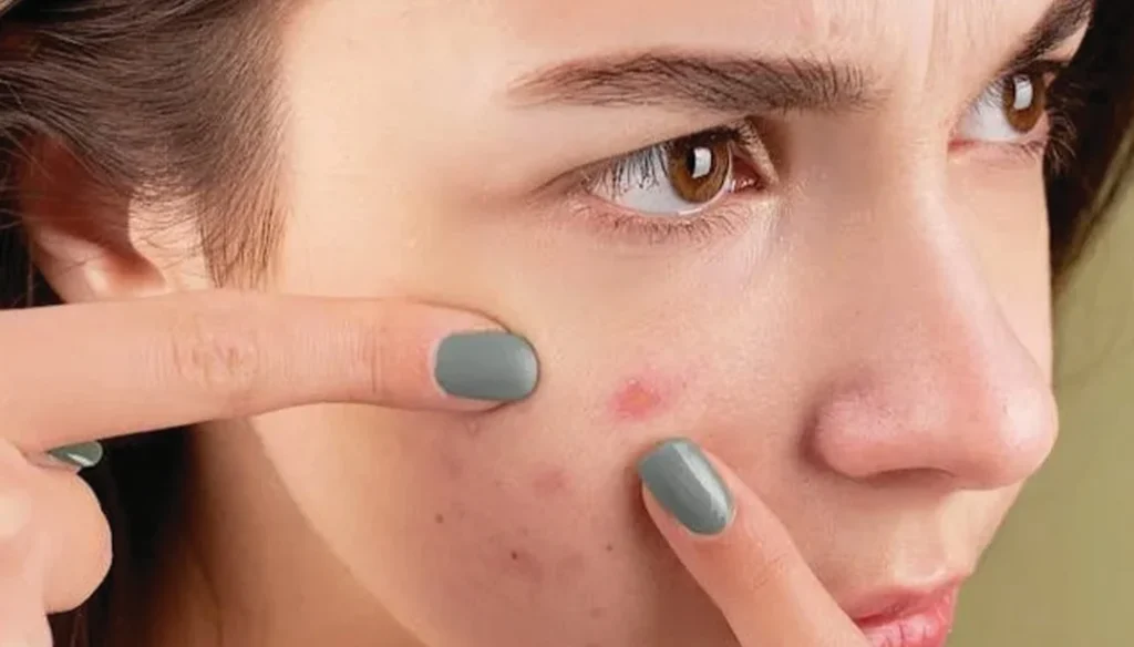 acne treatment in Dubai