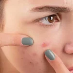 acne treatment in Dubai