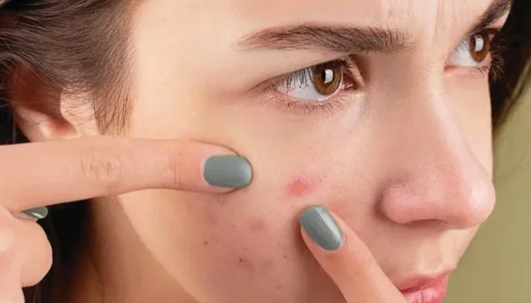 acne treatment in Dubai