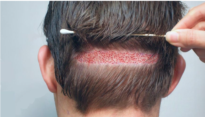 Best Hair Transplant in Lahore