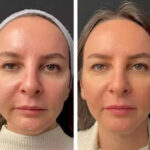 Mesotherapy treatment in Dubai