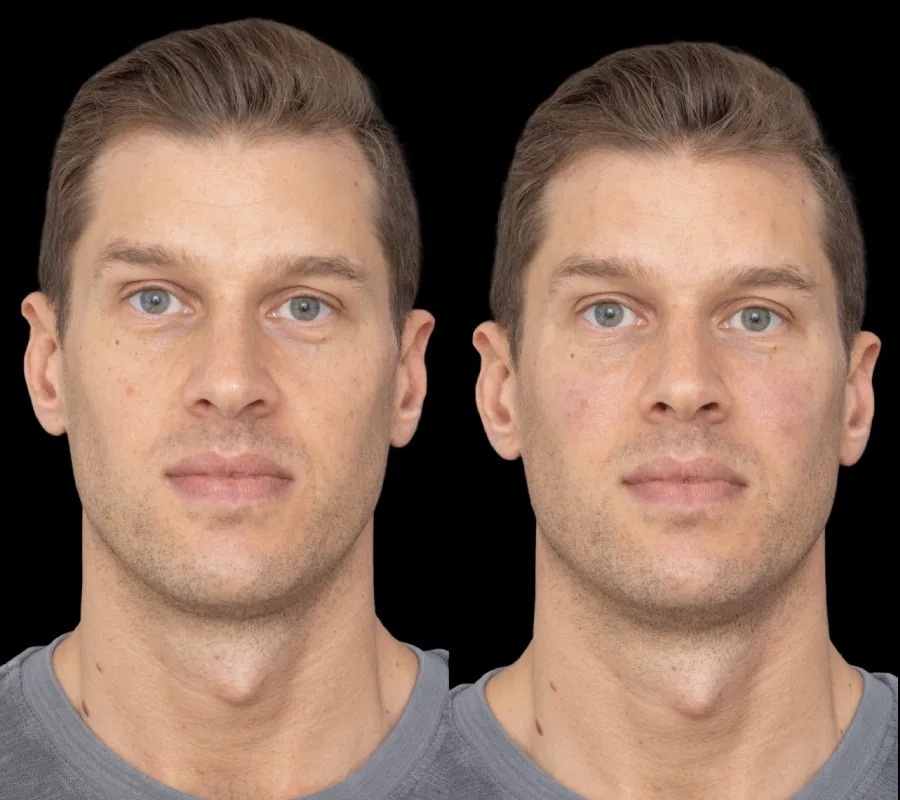 Under Eye Fillers in Dubai