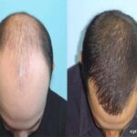 Hair Restoration in Novi