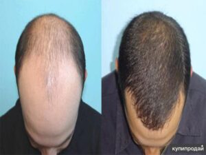 Hair Restoration in Novi