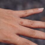 flat warts in youth