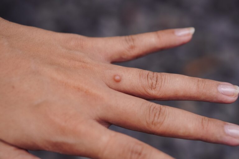 flat warts in youth