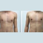 H1-Gynecomastia