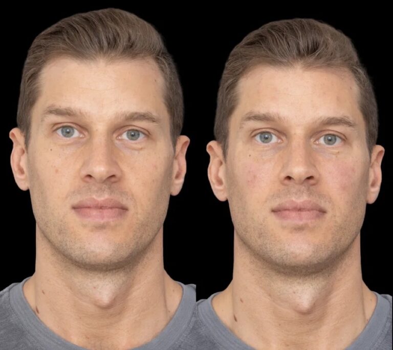 under eye fillers