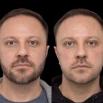 under eye fillers in dubai