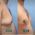 best gynecomastia in islamabad