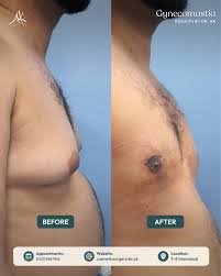best gynecomastia in islamabad