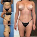 body contouring