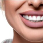 Hollywood Smile makeover in Dubai