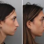 Rhinoplasty Before and After
