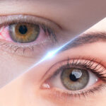 Ayurvedic Eye Diseases Treatment in Dubai