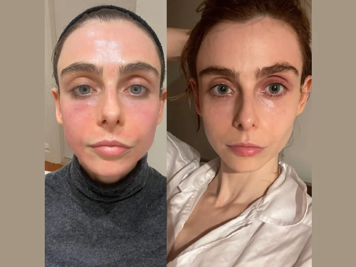 H10-RF-Microneedling