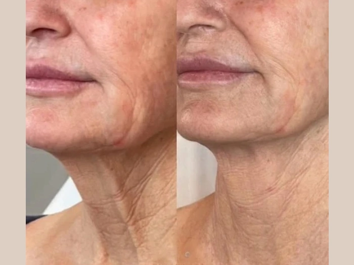 H6-Moxi®-Laser-treatment