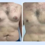 gynecomastia in dubai.jpg