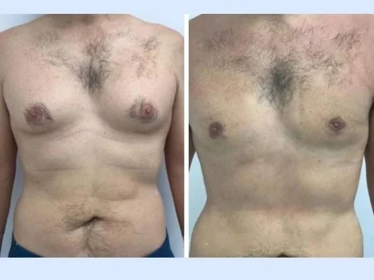 gynecomastia in dubai.jpg