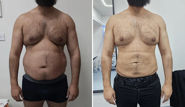 liposuction before and after