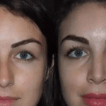 nose surgery in dubai