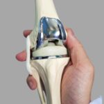 Best Knee Replacement Surgeon in Jaipur