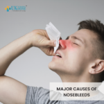 Major causes of Nosebleeds