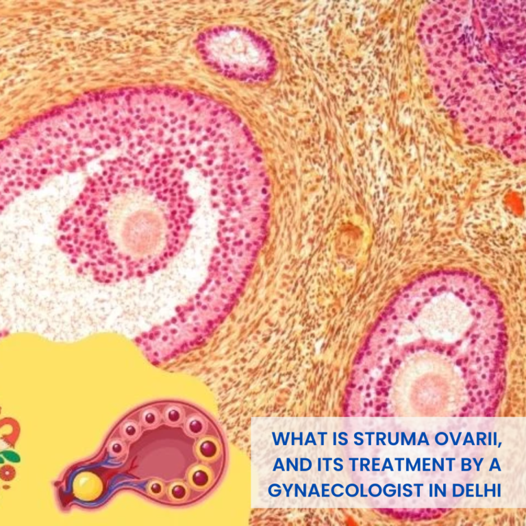 What is Struma Ovarii, and its treatment by a gynaecologist in Delhi