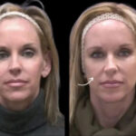 sculptra fillers in dubai jpg new