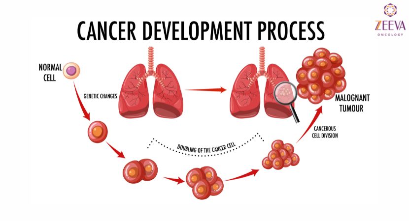 Best Lung Cancer Treatment in Noida
