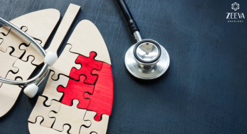 Lung Cancer Treatment in Noida