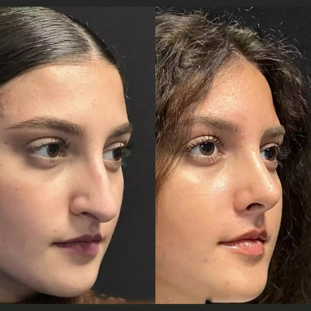 Rhinoplasty in Dubai