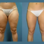 Radiofrequency (RF) Microneedling in Dubai