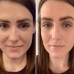 Prp Treatments in Dubai