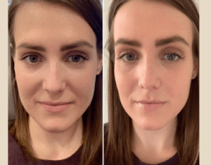 Prp Treatments in Dubai