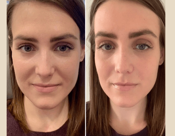 Prp Treatments in Dubai