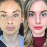 Luxury Radiofrequency (RF) Microneedling Treatments in Dubai