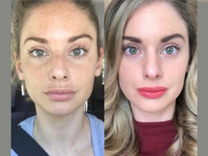 Luxury Radiofrequency (RF) Microneedling Treatments in Dubai