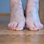 diabetic foot ulcer clinical trials