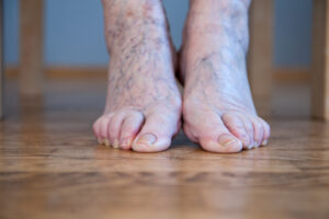 diabetic foot ulcer clinical trials