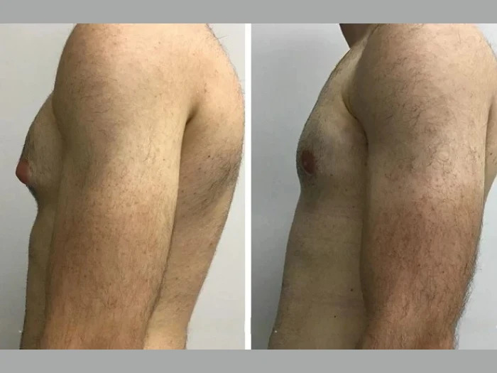 gynecomastia in Dubai