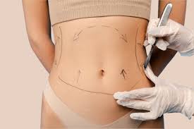 liposuction in dubai
