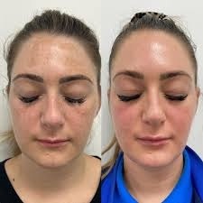 Cosmelan Pigmentation Treatment in Altrincham