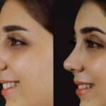 Septoplasty in Dubai