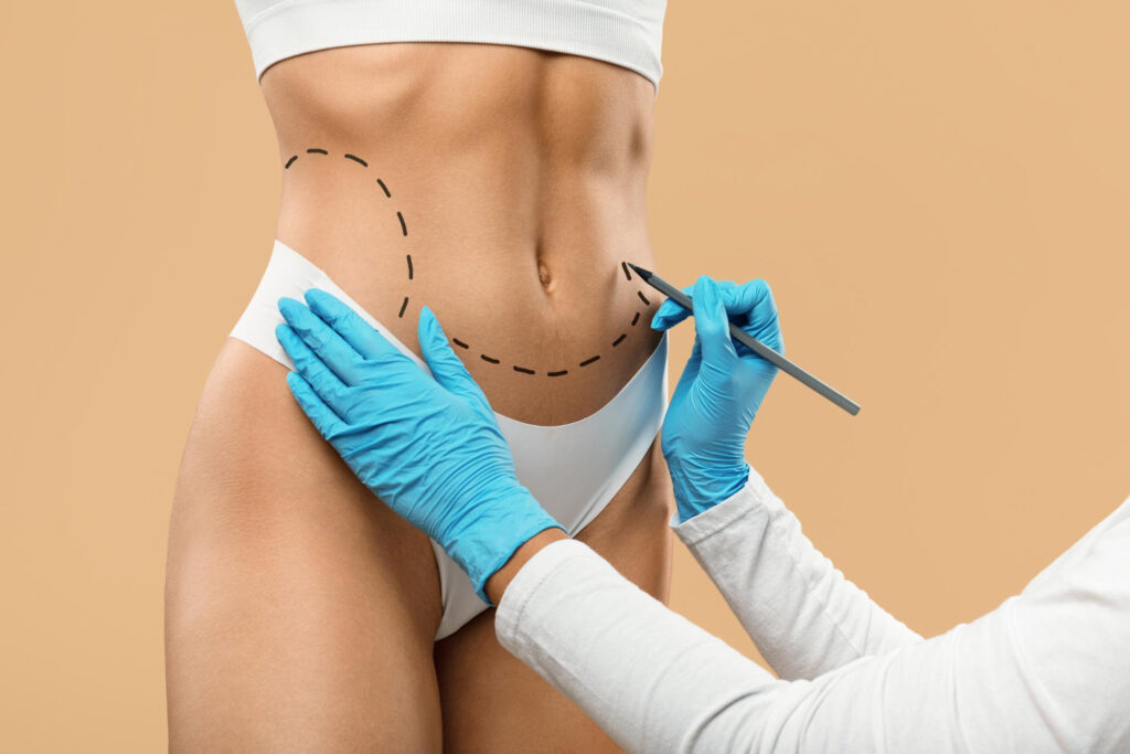 360 Liposuction Dubai