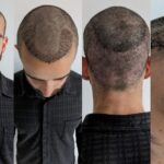 Medications vs Hair Transplant