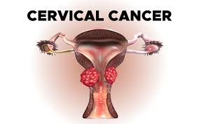cervical cancer treatment